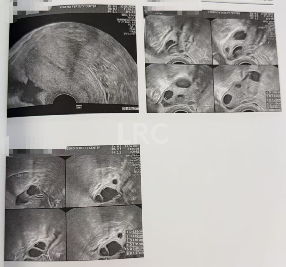 28岁卵巢早衰，卵泡大小乱成一团，LRC个性化促排全程监测，最终5颗受精卵全部成囊！