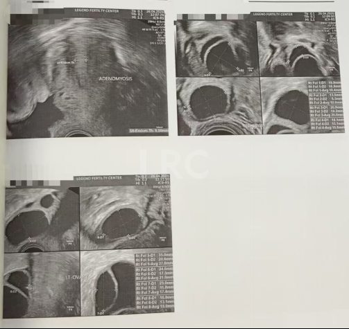 28岁卵巢早衰，卵泡大小乱成一团，LRC个性化促排全程监测，最终5颗受精卵全部成囊！