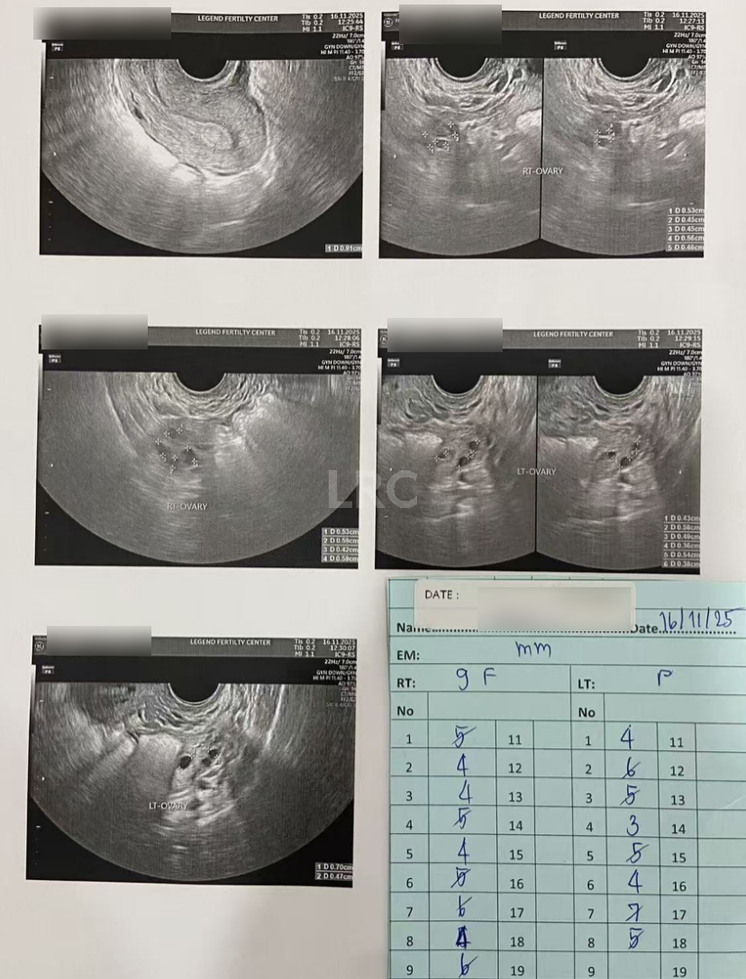 男方69岁重度弱精翻盘！LRC DGC高密梯度离心法+个性化促排方案，6周见胎心