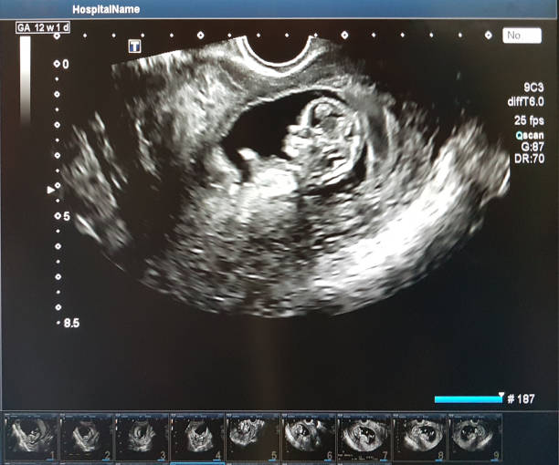 子宫内膜异位症能做试管婴儿吗？