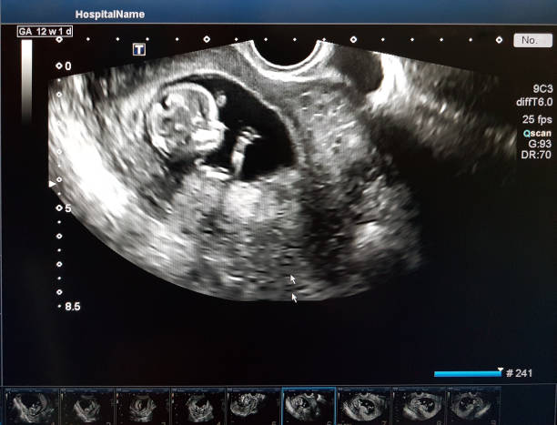 子宫腺肌病 可以做试管婴儿吗？
