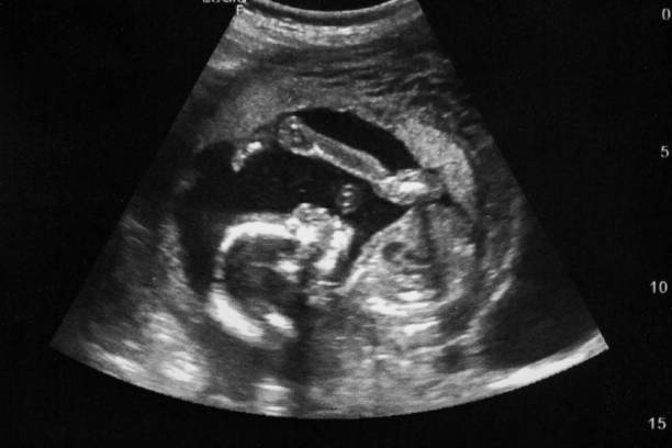 子宫息肉能做试管婴儿吗？